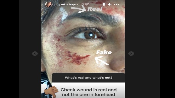 प्रियंका चोपड़ा को लगी चोट प्रियंका चोपड़ा को लगी चोट